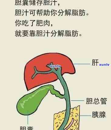 胆总管结石能喝茶叶茶吗，胆总管结石患者能否饮用茶叶茶？