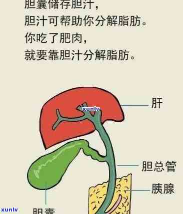 胆结石患者可以喝茶吗？影响因素有哪些？