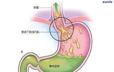 胃食管反流能喝茶吗？原因解析