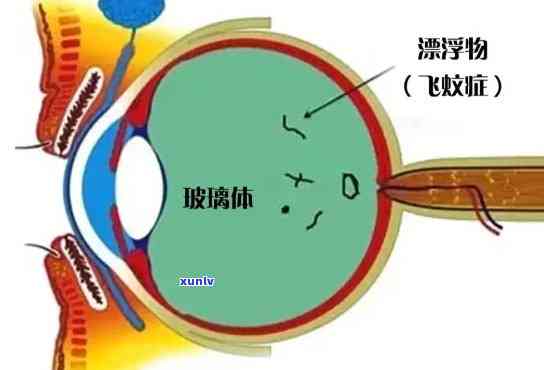 双眼皮玻璃体混浊是什么？与双眼皮窗户有何关联？