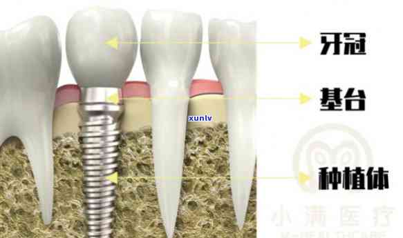 什么叫小冰种植牙？详解新型口腔修复技术