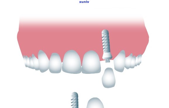 什么叫小冰种植牙？详解新型口腔修复技术