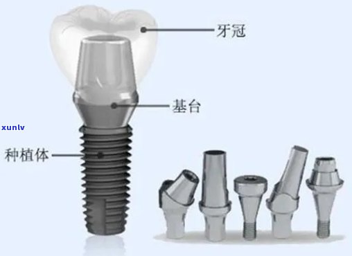 什么叫小冰种植牙？详解新型口腔修复技术