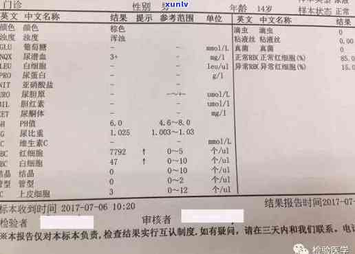 小便茶叶色、右腰疼原因解析：女性尿液异常与腰痛关联性探讨