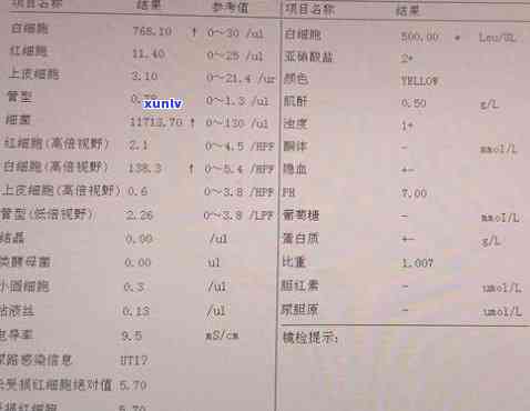 小便茶叶色、右腰疼原因解析：女性尿液异常与腰痛关联性探讨