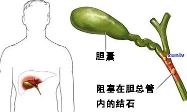 胆结石可不可以喝茶，喝茶对胆结石有影响吗？可以喝吗？