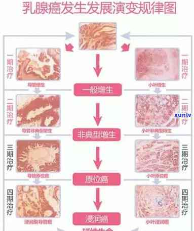 小叶增生能否饮用奶茶？专家解析