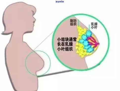 小叶增生能否饮用奶茶？专家解析