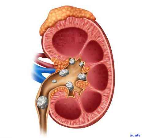 尿结石能不能喝茶叶-尿结石能不能喝茶叶水