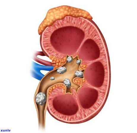 尿结石能不能喝茶叶-尿结石能不能喝茶叶水