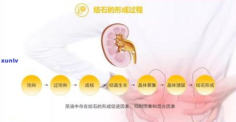 结石可以喝茶叶茶吗-结石可以喝茶叶茶吗男性