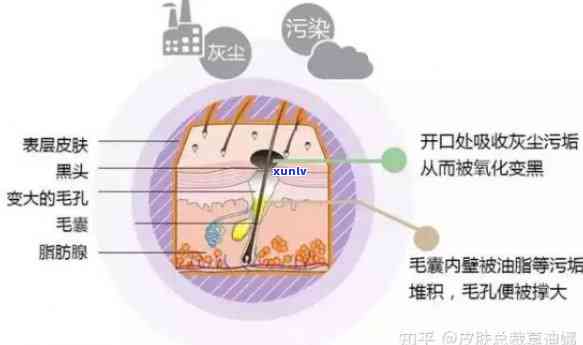 黑毛孔是什么原因造成的？如何解决粗大的黑毛孔问题？