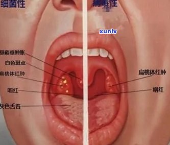 喝普洱加重扁桃体炎