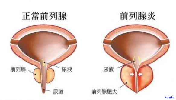 普洱茶：前列腺炎的天然疗法？如何正确饮用以获得效果？