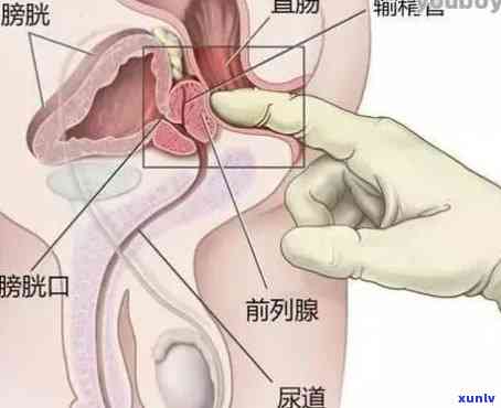 普洱茶：前列腺炎的天然疗法？如何正确饮用以获得效果？