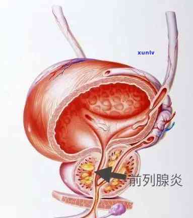 普洱茶对前列腺功效：男士健利器与前列腺炎的关系探讨