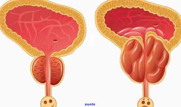 普洱茶对前列腺功效：男士健利器与前列腺炎的关系探讨