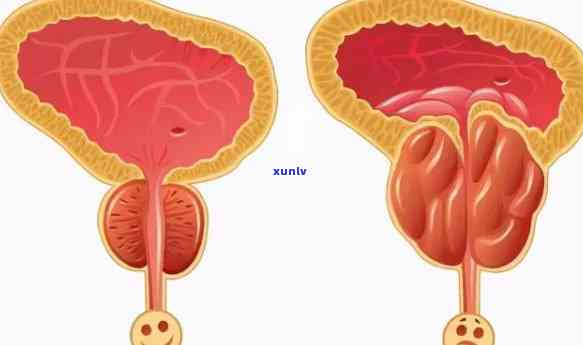 普洱茶对前列腺功效：男士健利器与前列腺炎的关系探讨