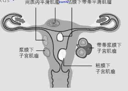 子宫腺肌瘤患者是否可以喝普洱茶？普洱茶对子宫腺肌瘤的影响及注意事项