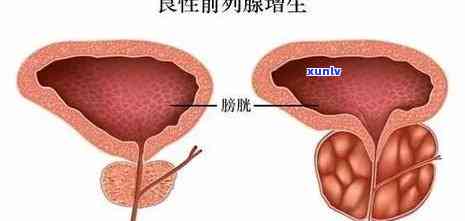 前列腺增生能喝普洱茶吗：男性、女性患者是否可饮？