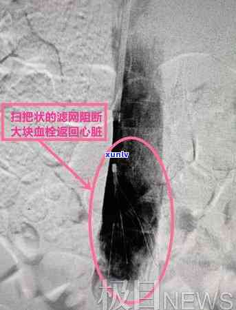 信用卡逾期后，亲人代偿是否会产生不良影响？