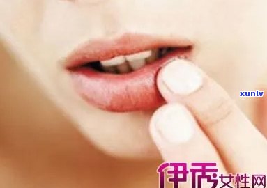 口角炎女性能喝普洱茶吗？