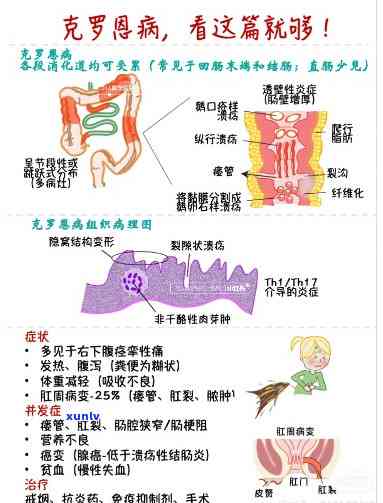 普洱茶对克罗恩病患者的影响及适宜饮用方式