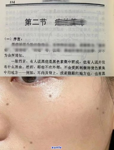 点痣后普洱茶禁忌：女生是否可以喝？需要注意什么？