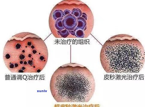 皮秒激光治疗后的饮食安排：普洱茶是否适用？