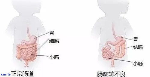 肠子打结怎么保守治疗：有效 *** 助您康复