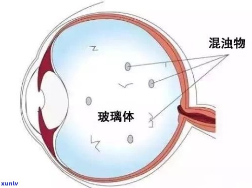 普洱茶能治飞蚊症吗？怎么喝？百度百科告诉你！