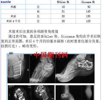 脚后跟骨折：严重程度、治疗 *** 与康复注意事项