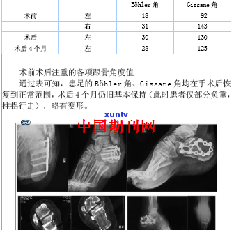 脚后跟骨折：严重程度、治疗 *** 与康复注意事项