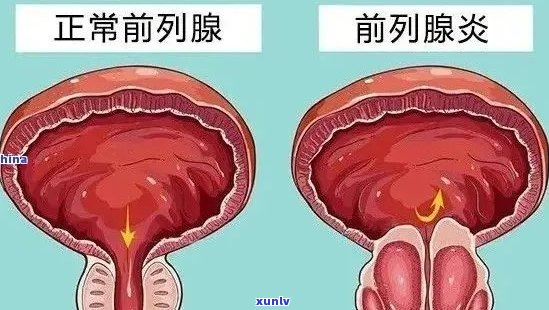 普洱茶治疗前列腺炎：真实效果及注意事项