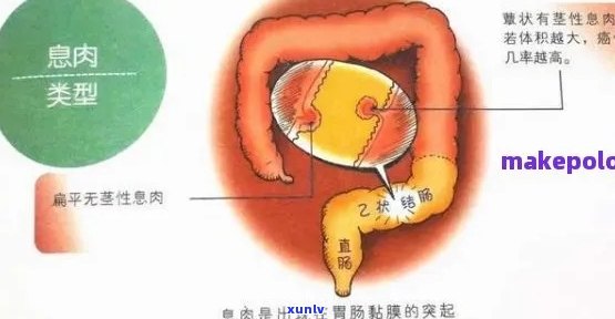 肠息肉能喝普洱茶吗