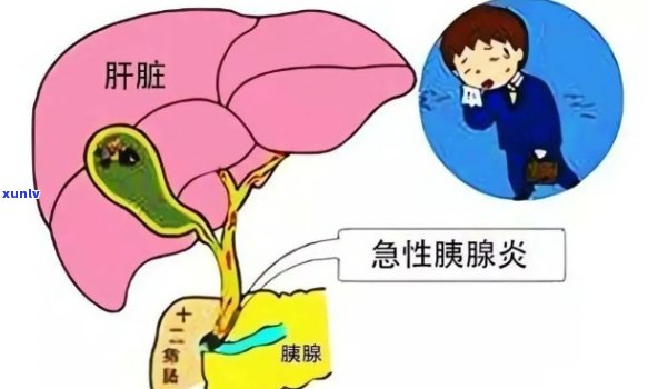 慢性胰腺炎与普洱茶：适宜与否？