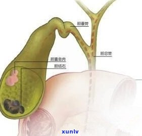 胆囊息肉患者饮食：茶叶摄入量需要注意吗？