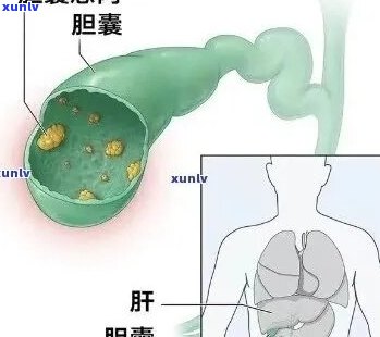 胆囊息肉患者饮食：茶叶摄入量需要注意吗？